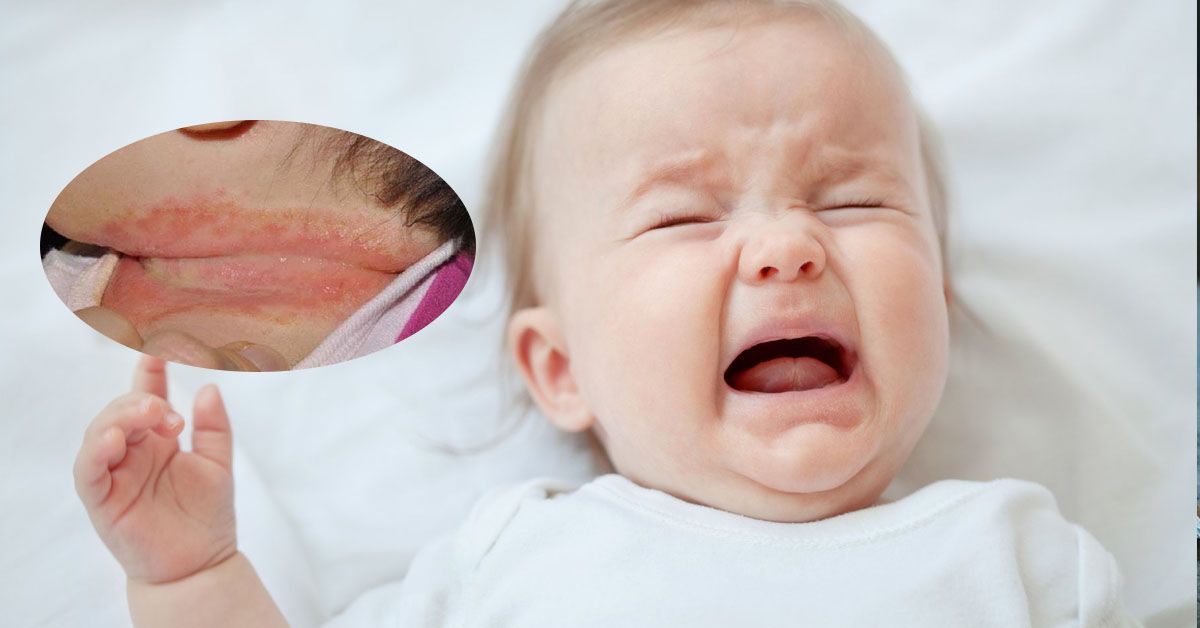 5 bước đơn giản chữa tình trạng trẻ bị hăm cổ