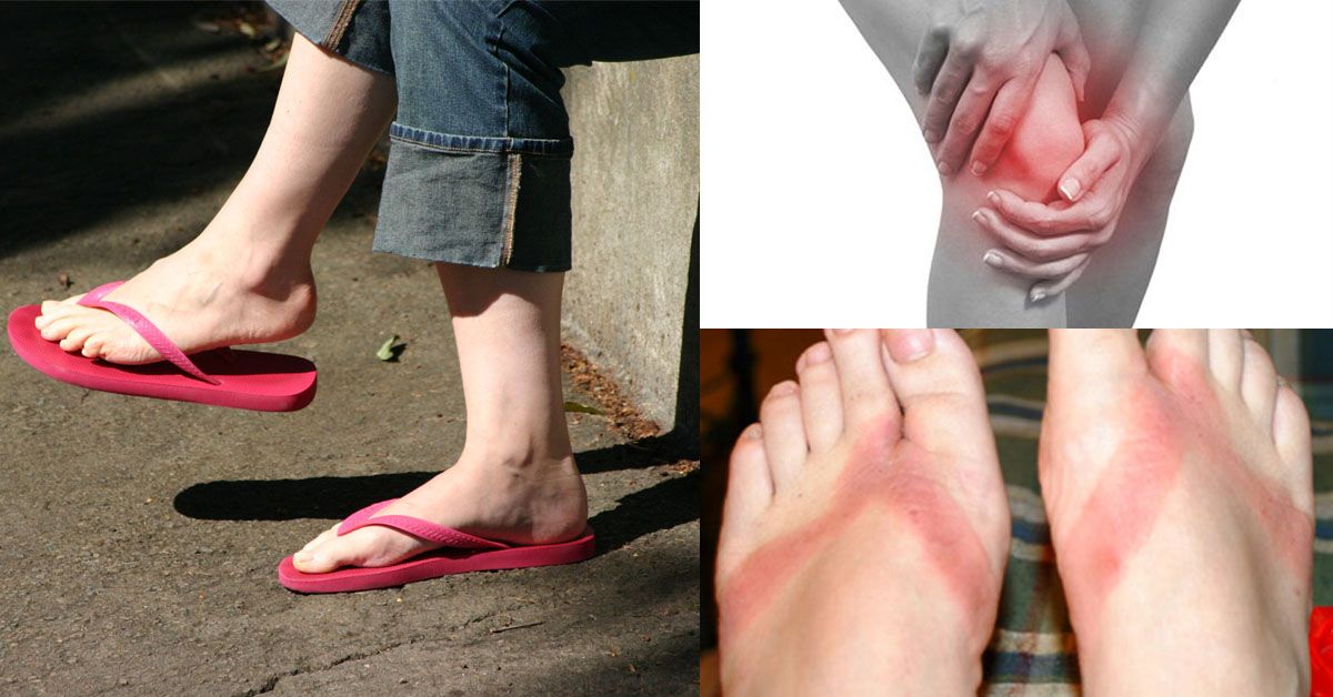 Nguy cơ mắc bệnh khi đi dép xỏ ngón, nếu thường xuyên mang dép này thì nên bỏ ngay kẻo hối hận