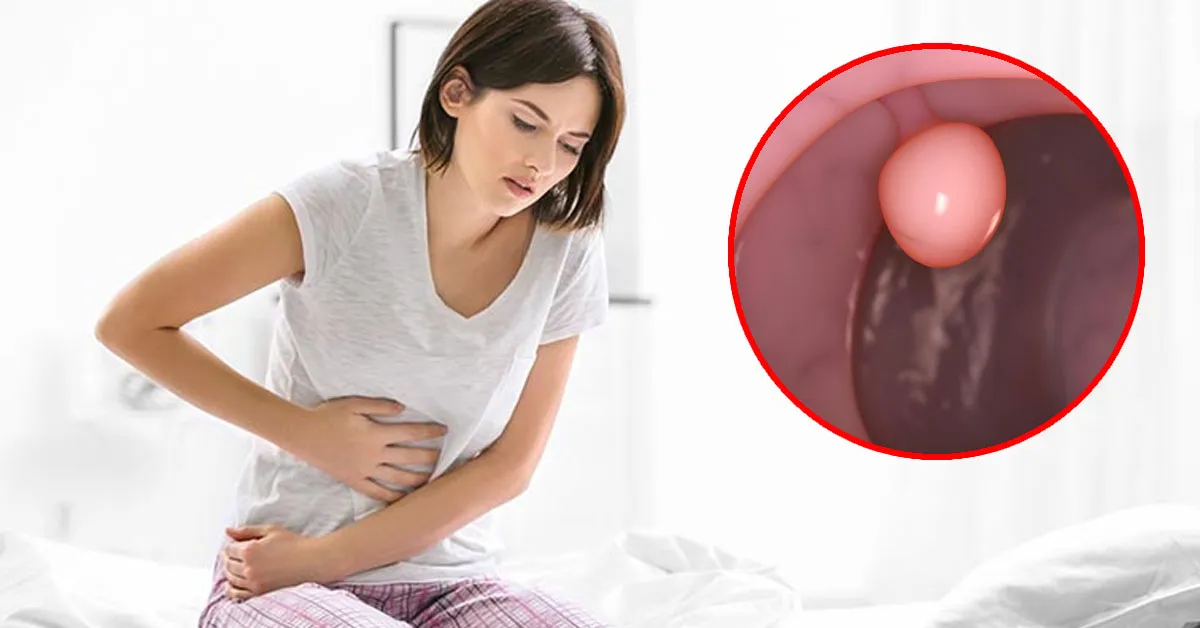 Làm sao để biết mình có mắc bệnh polyp cổ tử cung hay không?