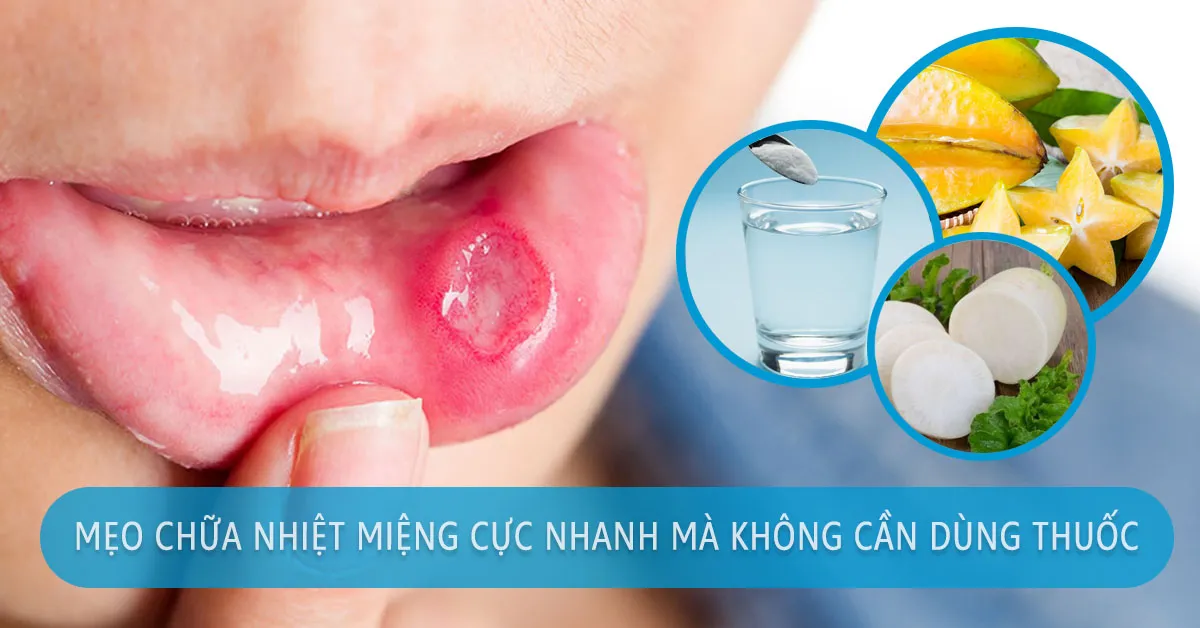 Không cần 1 viên thuốc nào, đây là cách trị đẹn nhanh và đơn giản nhất