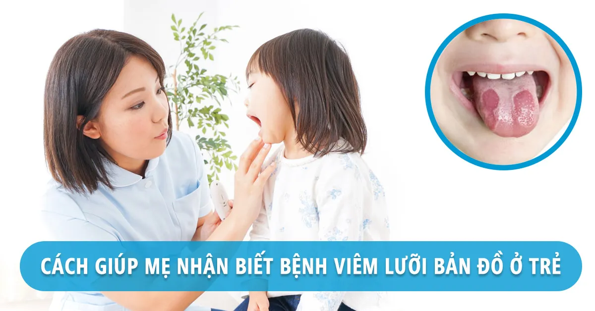 Mẹ cần nhận biết sớm bệnh viêm lưỡi bản đồ ở trẻ để giúp con mau khỏi