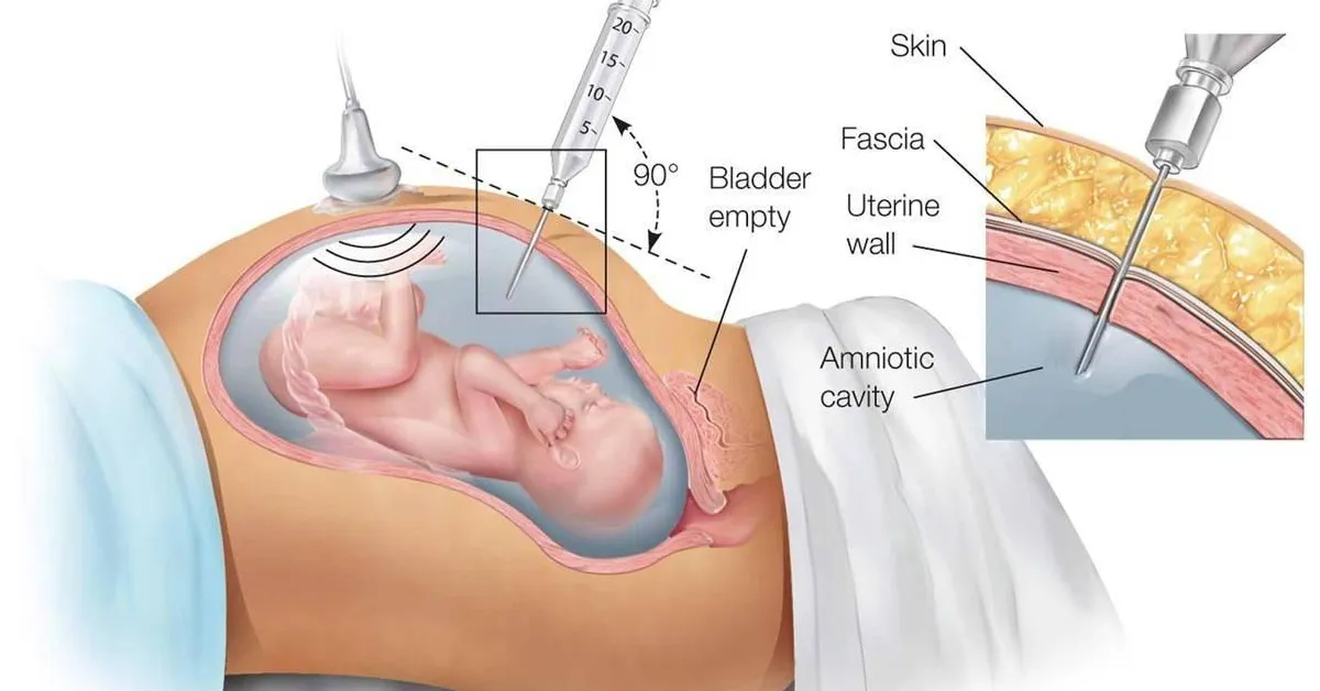 Chọc ối – Xét nghiệm giúp phát hiện sớm những bất thường ở thai nhi