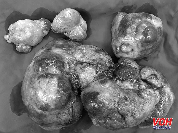 Cẩn trọng với khối u vùng bụng