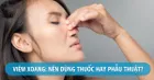 Viêm xoang là gì ? Biện pháp phòng ngừa và chữa trị bệnh tốt nhất