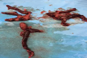 Cứu sống bệnh nhân bị thuyên tắc phổi toàn bộ hai bên