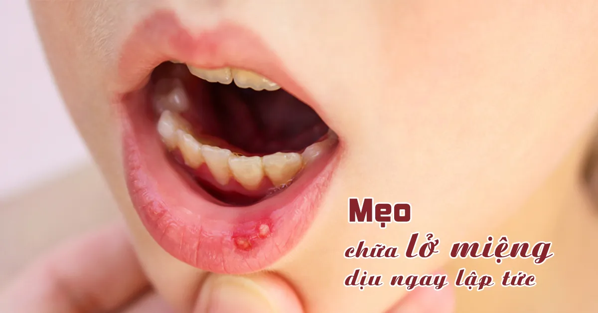 Bác sĩ chia sẻ cách chữa lở miệng theo Đông y đơn giản mà hiệu quả