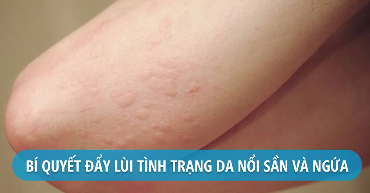 Da nổi mẩn ngứa phải làm sao?