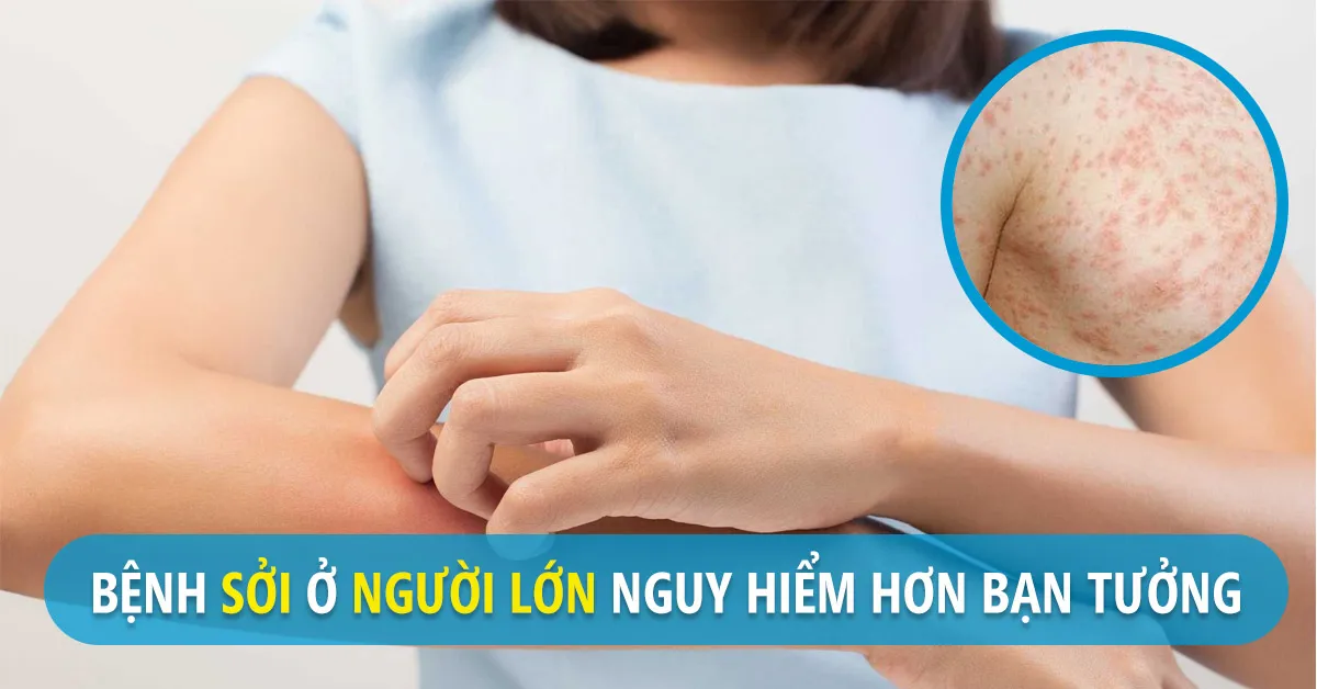 Bệnh sởi ở người lớn nguy hiểm hơn bạn tưởng