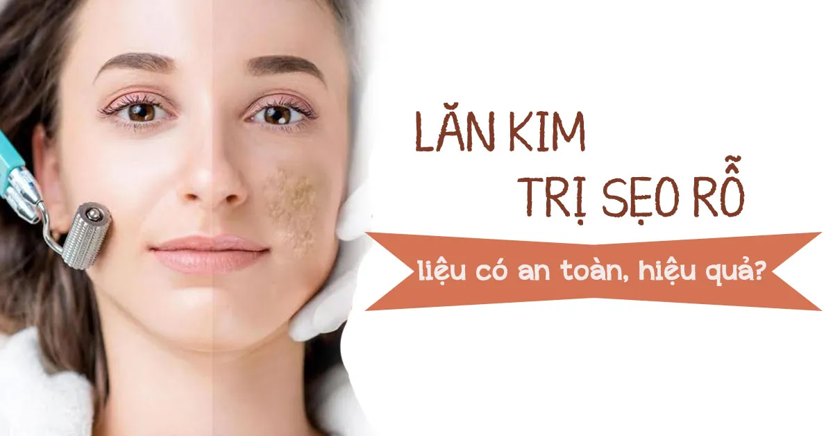 Phương pháp lăn kim trị sẹo rỗ có an toàn, hiệu quả không?