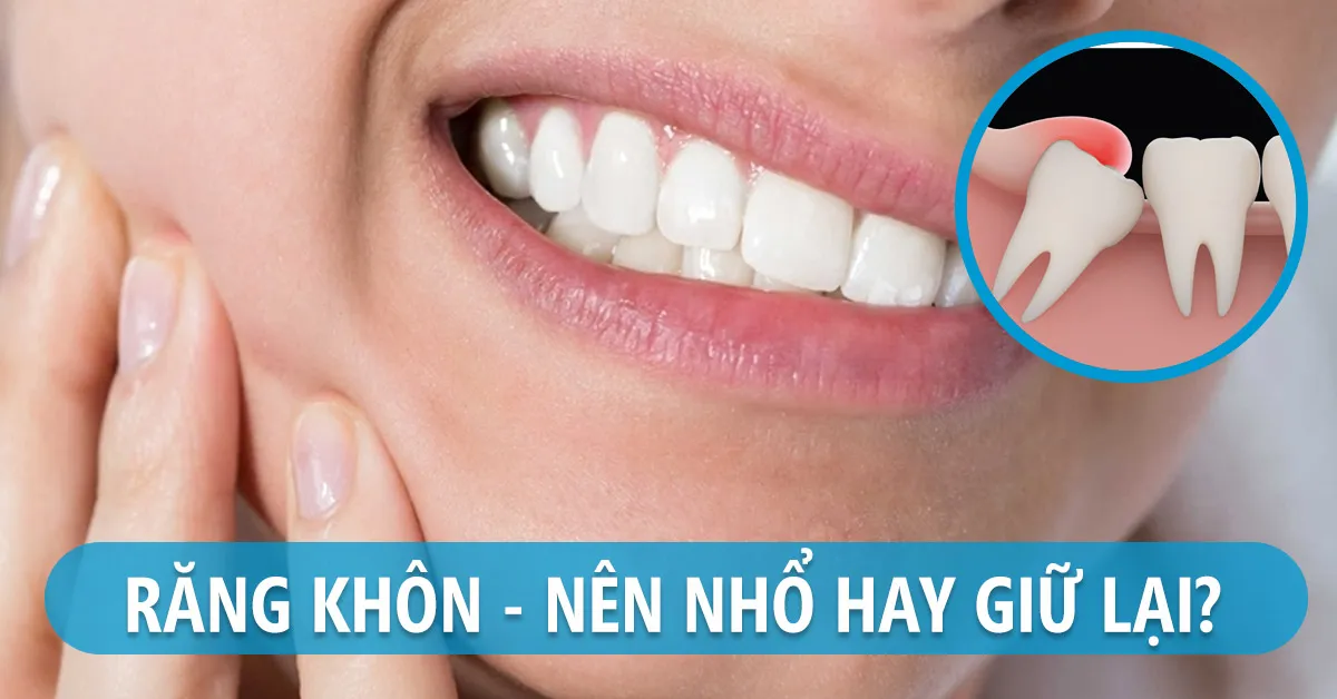 Nhổ răng khôn: Nên hay không nên?