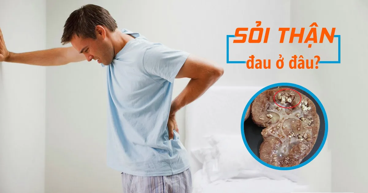 Đau sỏi thận thường xảy ra ở vị trí nào? Đau sỏi thận phải làm sao?