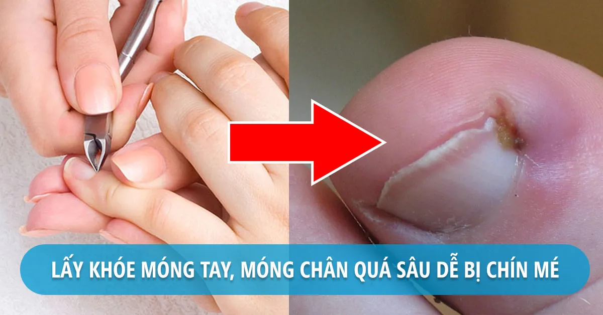 Bị chín mé là gì? Có nguy hiểm không?