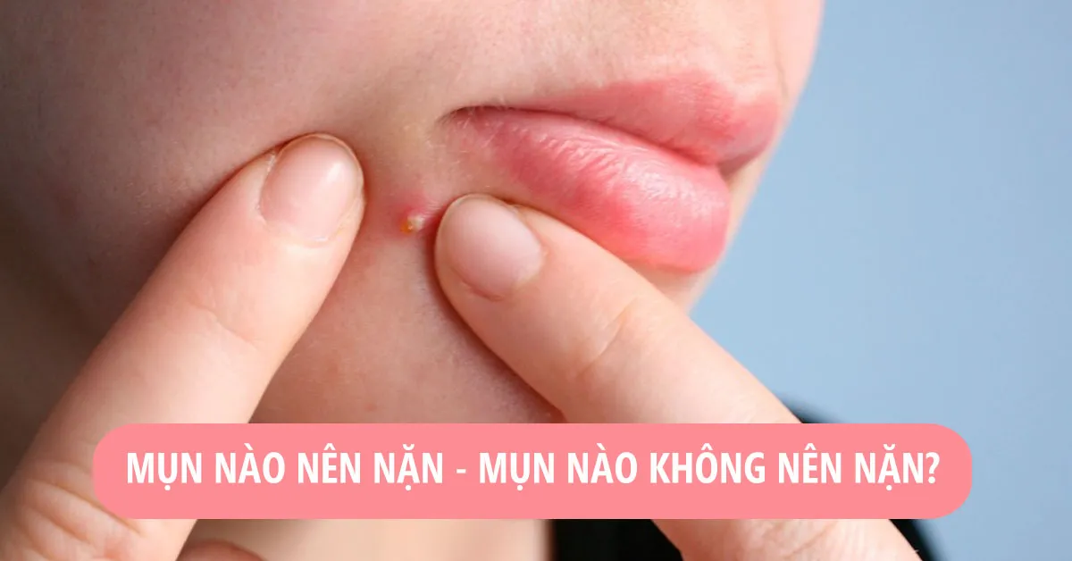 Có nên nặn mụn không? - vấn đề gây nhiều tranh cãi