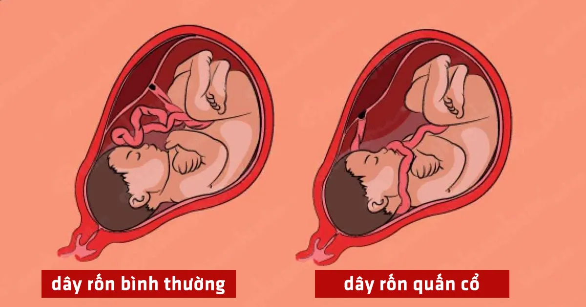 Thai nhi bị dây rốn quấn cổ có nguy hiểm không?