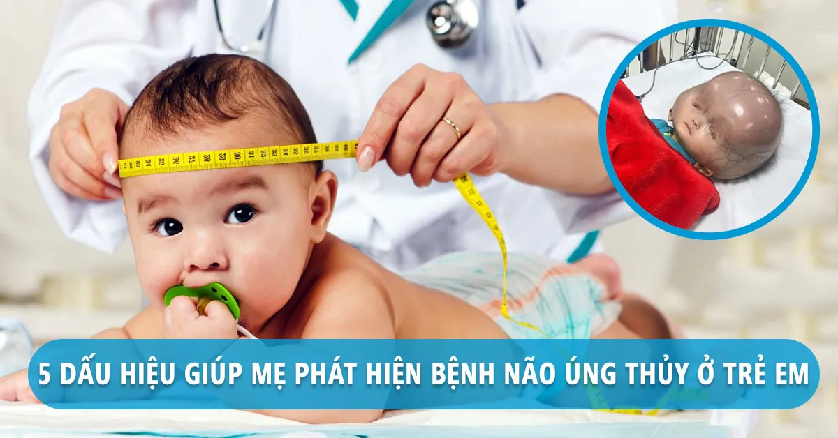 Bệnh não úng thủy là gì và có thể chữa được không?