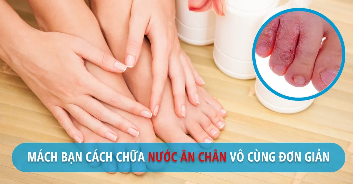 Thuốc và mẹo chữa nước ăn chân cực hay