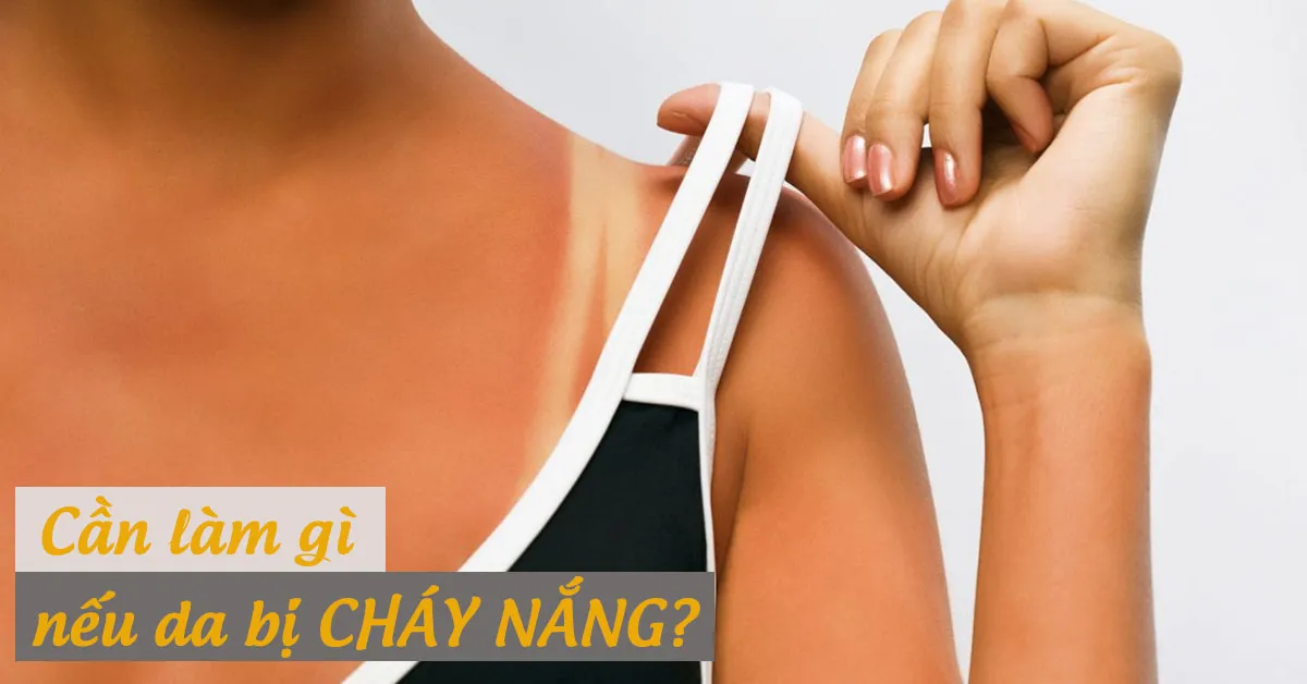 Da bị cháy nắng cần được chăm sóc như thế nào?