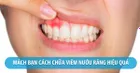 Viêm nướu răng điều trị bằng cách nào?