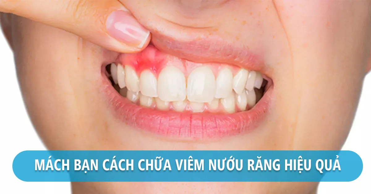 Viêm nướu răng điều trị bằng cách nào?