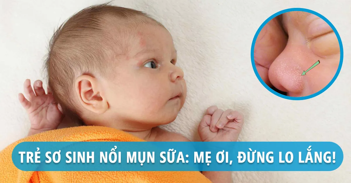 Mụn sữa ở trẻ sơ sinh: Nguyên nhân và cách chăm sóc