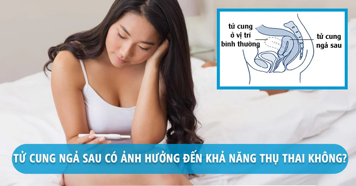 Tử cung ngả sau khiến phụ nữ khó mang thai?