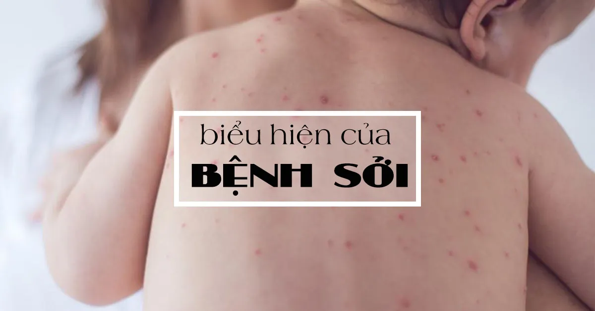 Cần chú ý 4 biểu hiện của bệnh sởi sau đây và cách điều trị kịp thời