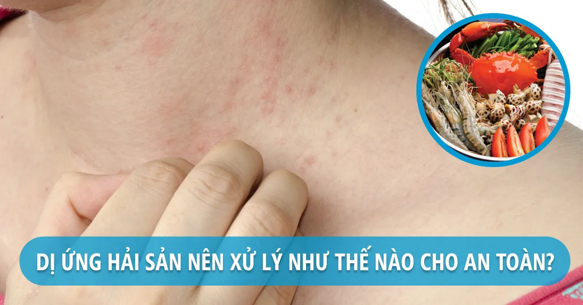 Dị ứng hải sản xử lý như thế nào cho đúng?