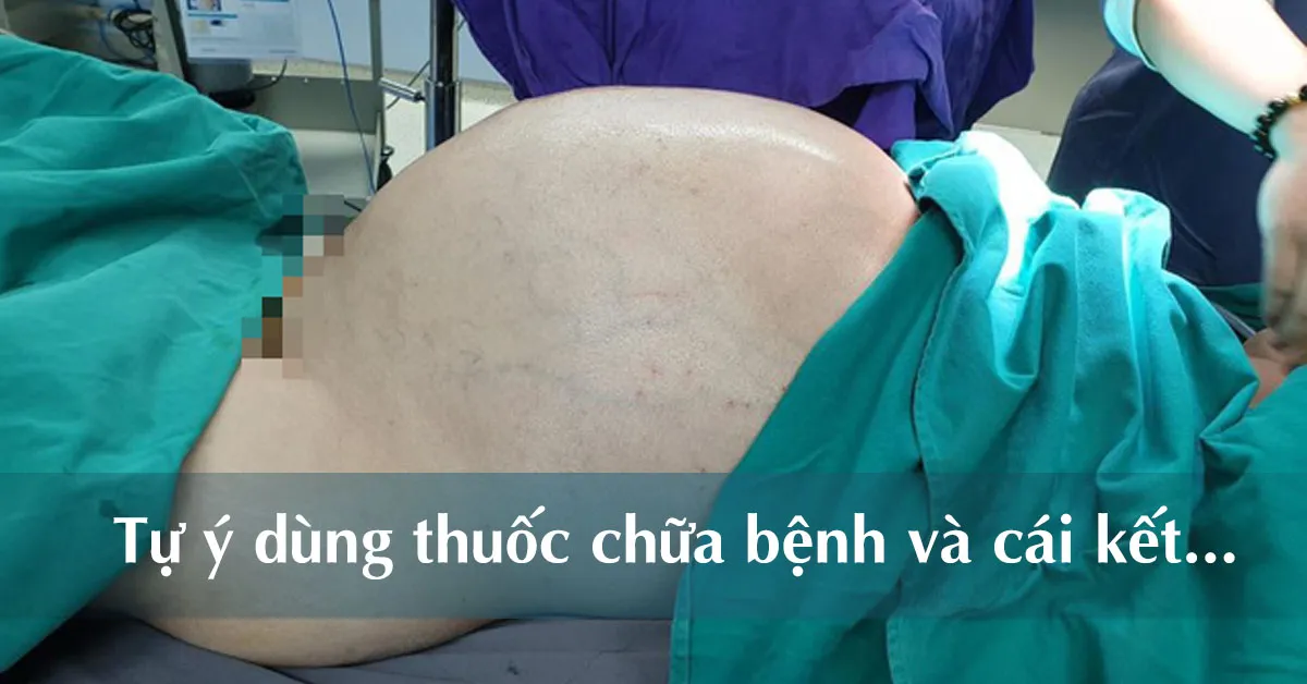 Thanh niên có khối u trong bụng 25 kg vẫn chỉ dùng thuốc nam chữa bệnh