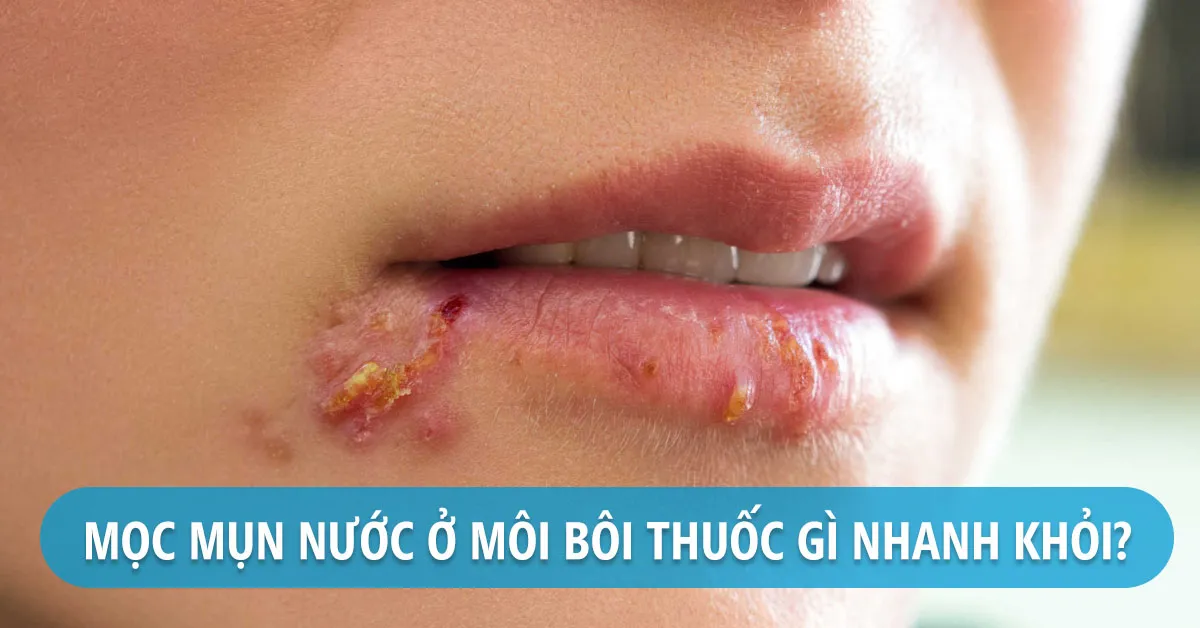 Mọc mụn nước ở môi là do đâu?