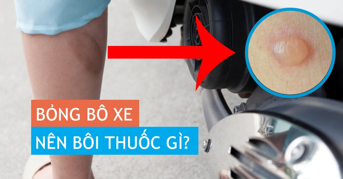 Bỏng bô – cách xử lý giúp nhanh khỏi nhất