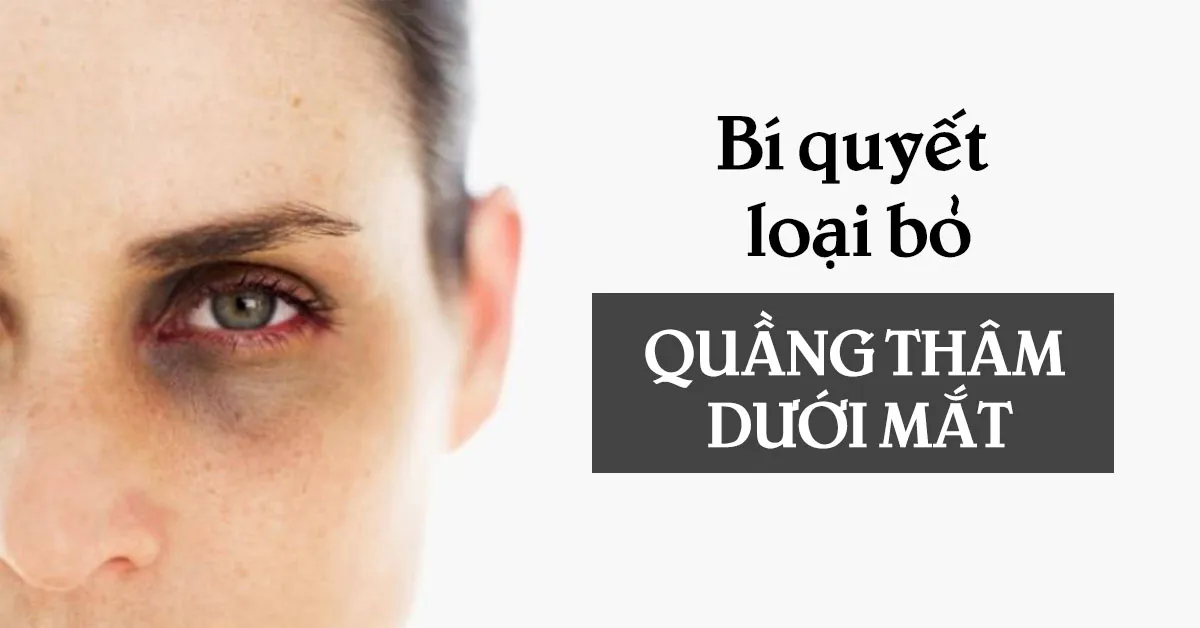 Quầng thâm dưới mắt là do bệnh gì gây ra?