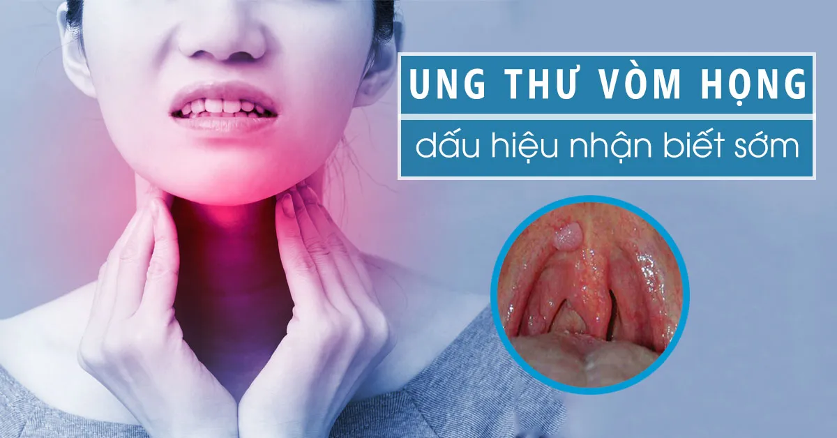 Ung thư vòm họng – nguyên nhân và dấu hiệu nhận biết sớm