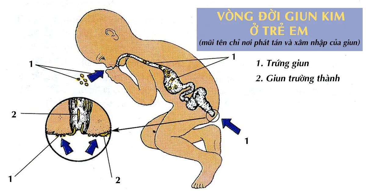 Nhận biết tình trạng nhiễm giun kim ở trẻ em và cách điều trị