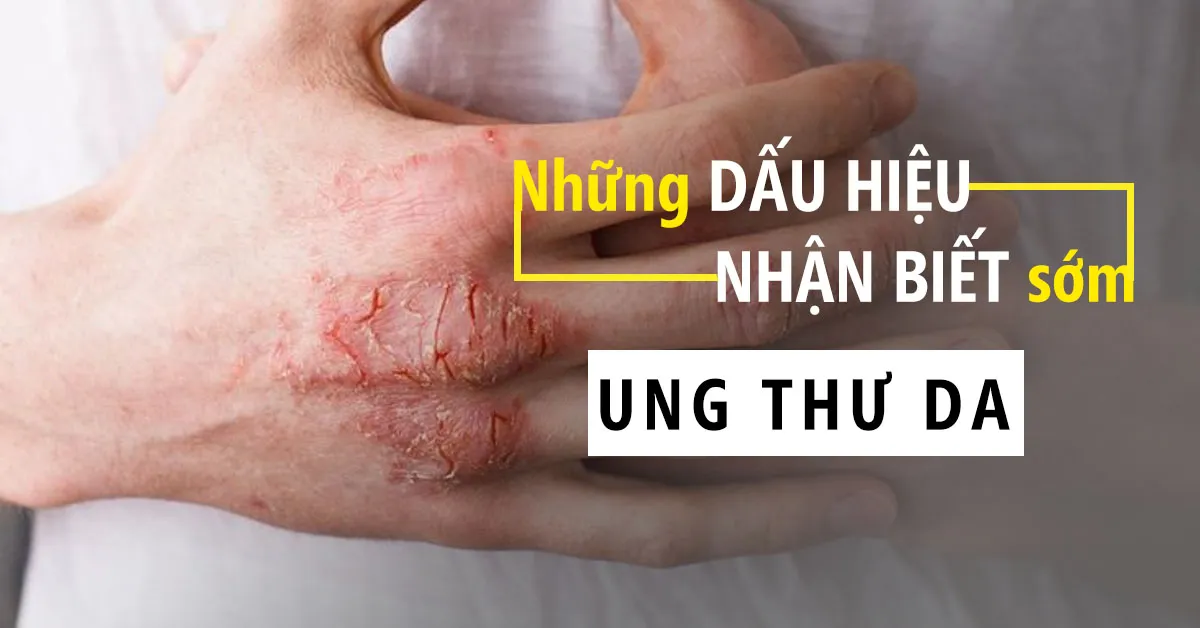 Ung thư da: Nguyên nhân, triệu chứng và cách điều trị