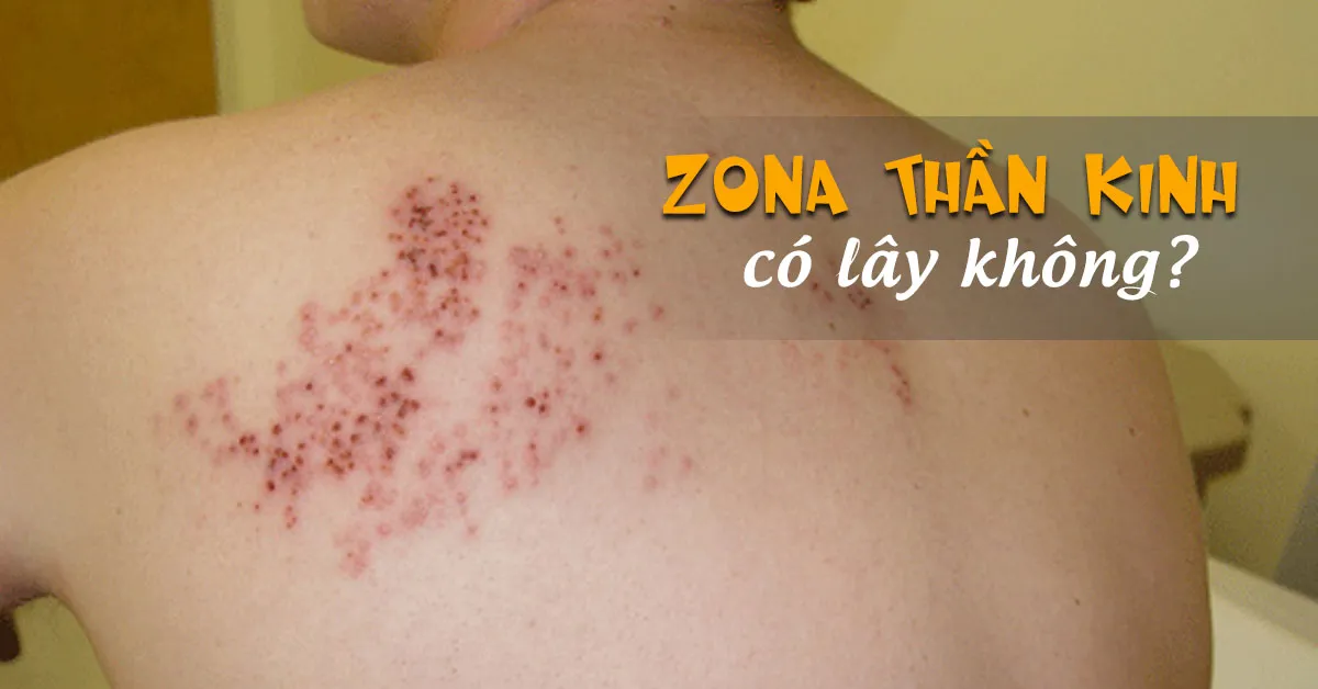 Zona thần kinh có lây không?