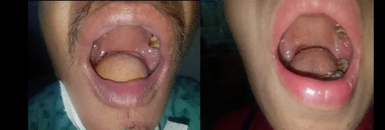 Gần 100 bệnh nhân ung thư được tái tạo thành công xương sọ - da đầu, xương hàm, lưỡi