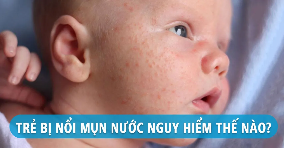 Trẻ bị nổi mụn nước: Nguyên nhân và cách điều trị