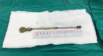 Sơ ý vấp té, thanh sắt xuyên não bệnh nhi 5 tuổi