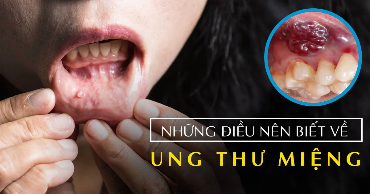 Ung thư miệng: Yếu tố nguy cơ, dấu hiệu nhận biết và điều trị