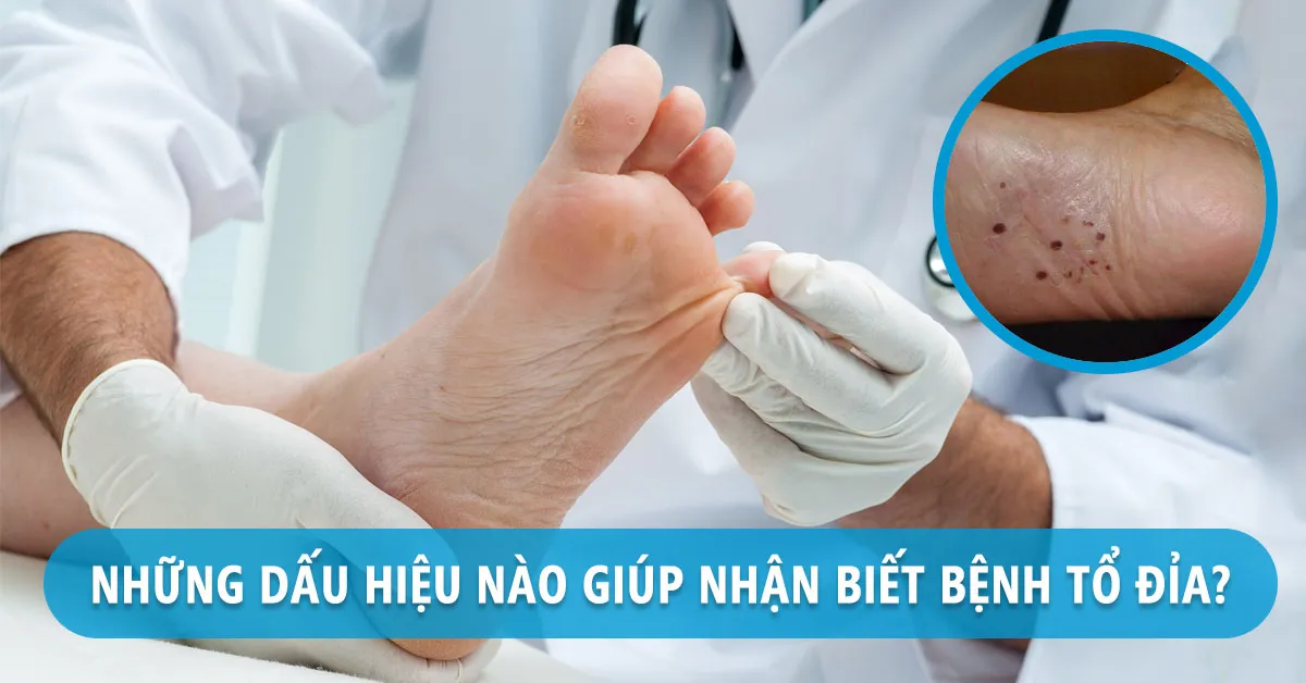 Bệnh tổ đỉa: Dấu hiệu nhận biết và cách điều trị