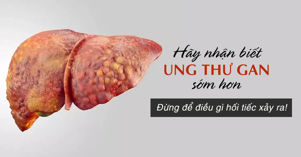 Ung thư gan – tất tần tật những điều nên biết ít nhất một lần