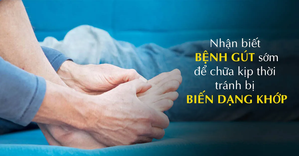 Dấu hiệu bệnh gout – phát hiện càng sớm điều trị càng dễ