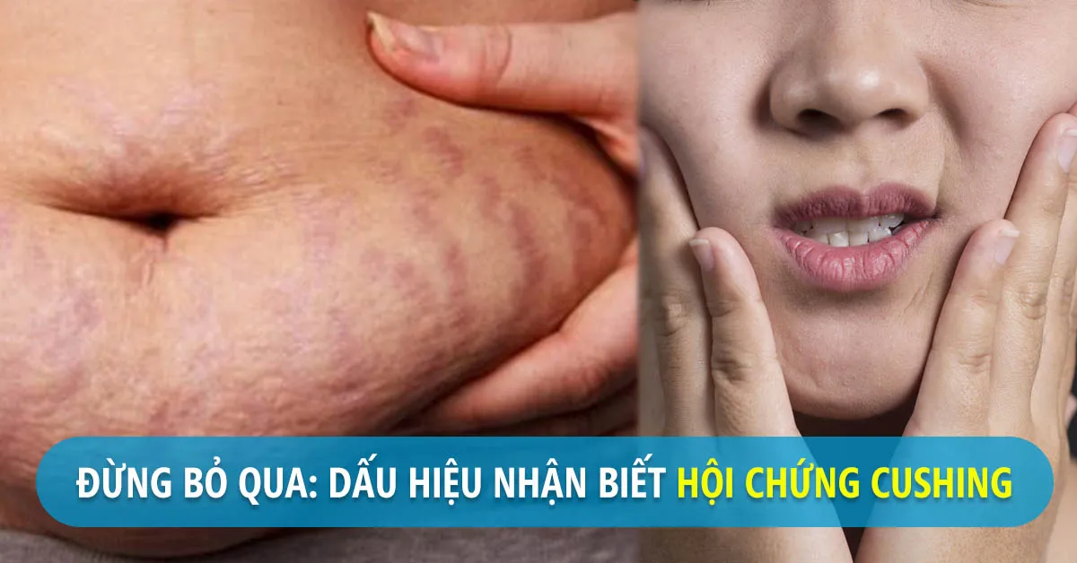 Hội chứng cushing là gì ? Cách chẩn đoán và điều trị bệnh kịp thời