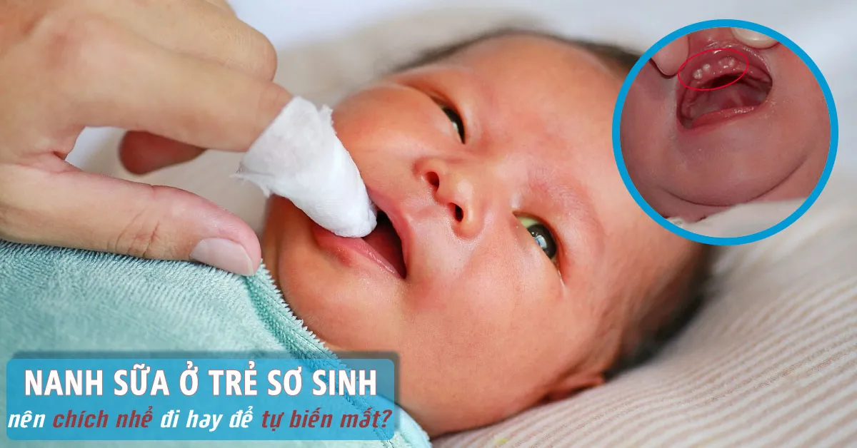 Nanh sữa ở trẻ sơ sinh xử trí thế nào mới đúng?