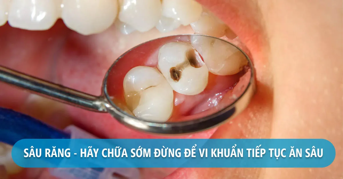 Sâu răng: Nguyên nhân, cách điều trị và phòng ngừa hiệu quả