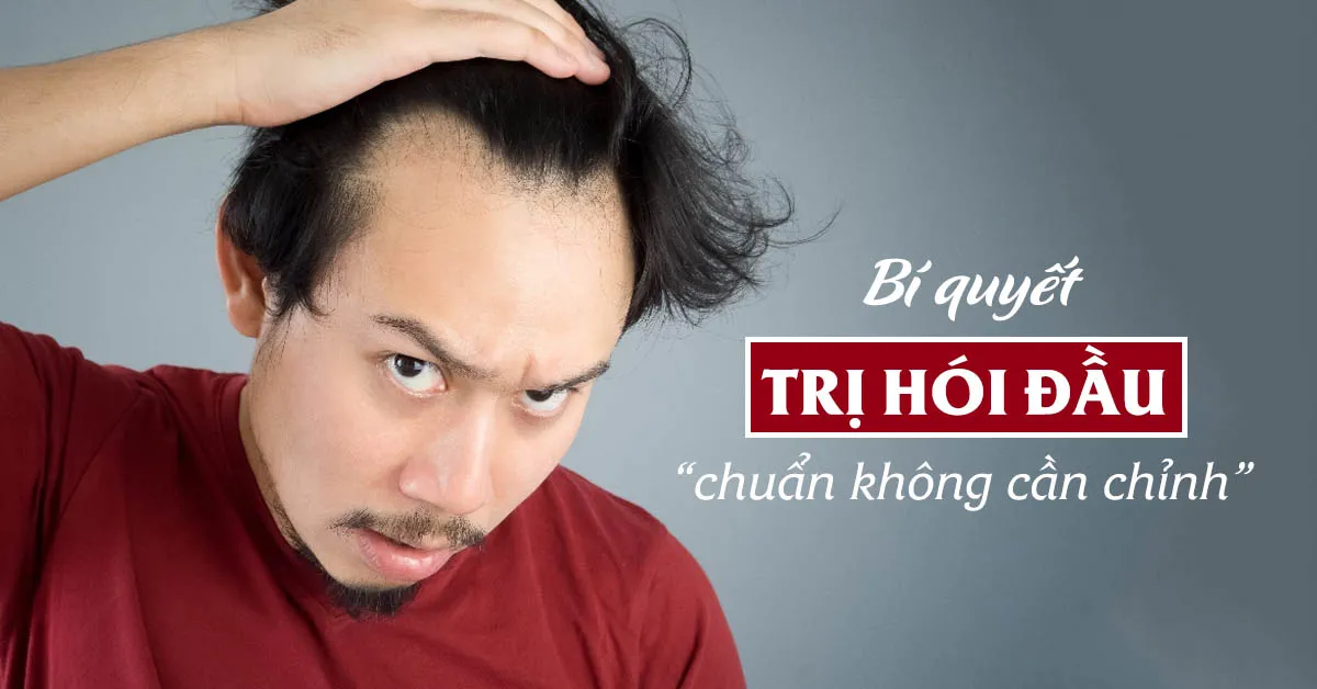 Hói đầu và những cách điều trị hiệu quả nhất