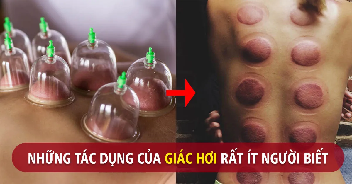 Những tác dụng của giác hơi và một số điều cần lưu ý