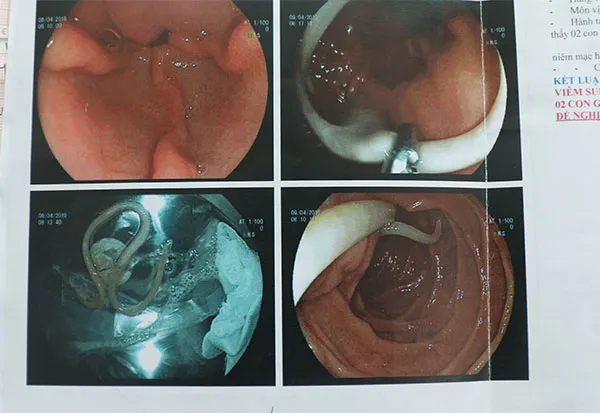 Tưởng viêm dạ dày, nào ngờ phát hiện giun làm tổ