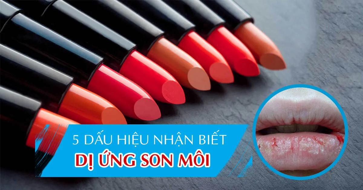 Dị ứng son môi: Nguyên nhân, biểu hiện và cách khắc phục