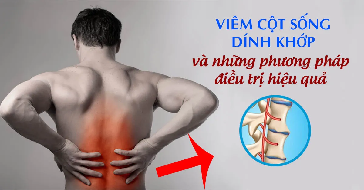 Viêm cột sống dính khớp là gì? Dấu hiệu nhận biết và cách điều trị